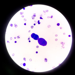 Abnormal cells in pleural fluid.