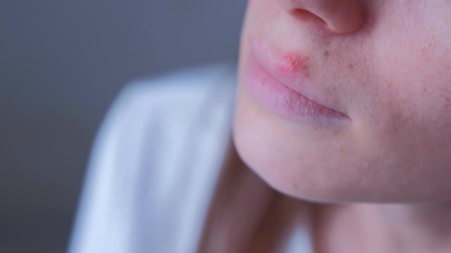 Herpes virus on human lips. Woman with herpes sore on lip mouth, closeup view. Process of dehydration during illness. Human papilloma virus, viral infection.