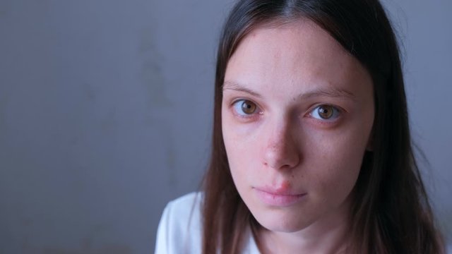 Portrait of sick woman with herpes virus sore on lip on mouth looking at camera on grey background. Process of dehydration during illness. Human papilloma virus, viral infection.