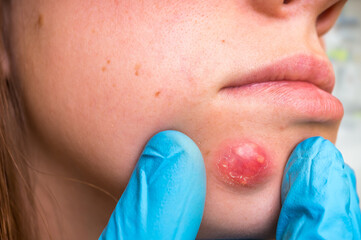 Woman with birthmark on her face, skin tags removal
