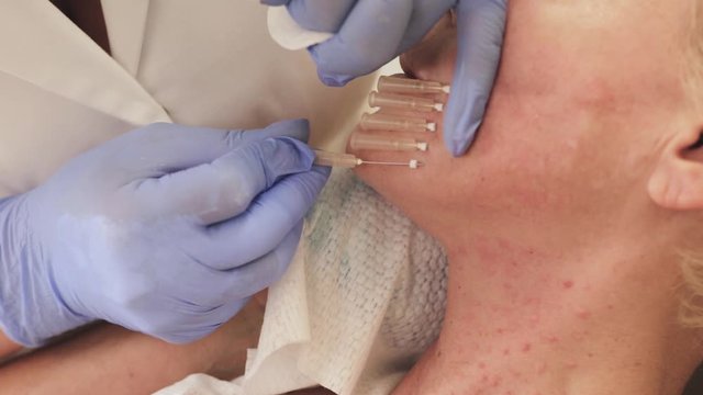 Doctor inserts needles into facial skin for thread lifting - aesthetic medicine