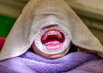 Patient with braces and a cheek retractor in a dental clinic
