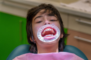 Patient with braces and a cheek retractor in a dental clinic