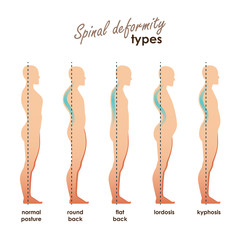 Spinal deformity types. Diseases of the spine.Lordosis, kyphosis, round back, flat back. Vector human silhouettes - obrazy, fototapety, plakaty