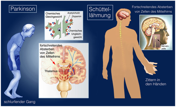 Parkinson. Sch&uuml;ttell&auml;hmung