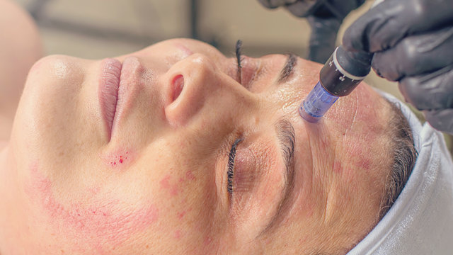 Needle mesotherapy treatment on a woman face.