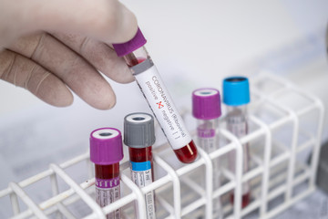 Woman with latex blue gloves is analyzing the blood sample with coronavirus.