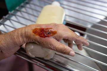 Wound on the hand of an old woman Doctors are apply on the wound.