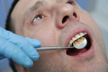 Closeup of a mouth with upper teeth cleaned of plaque. Dentist examines a patient in a dental...