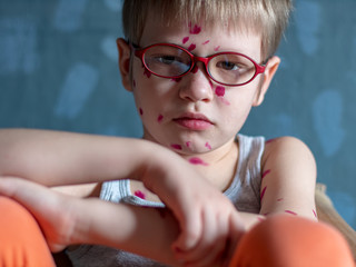 Upset blond child in pink glasses in straw chair has chicken pox. Mother smeared follicles with...