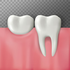 Realistic Vector illustration of teeth on gum. Transparent background.