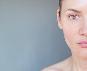 the girl has red vessels on her face