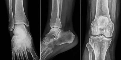  x-ray film of human foot and knee