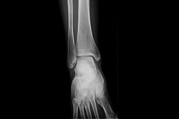 x-ray film of human foot