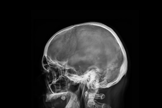 Radiography x-ray film of human skull
