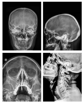 x-ray film of human skull and paranasal sinuses