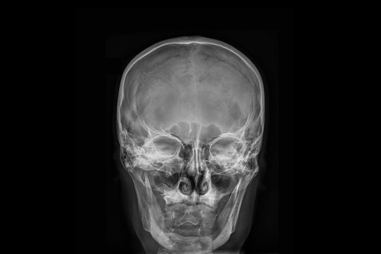Radiography x-ray film of human skull