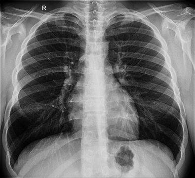 Radiography x-ray film of human chest