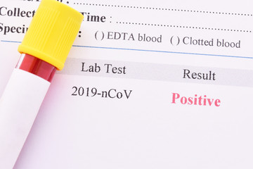 Positive test result of coronavirus 2019 or 2019-nCoV, novel coronavirus found in Wuhan, China