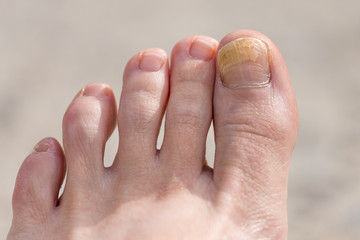 A close up of a toenail with fungal infection or psoriasis with a light background.