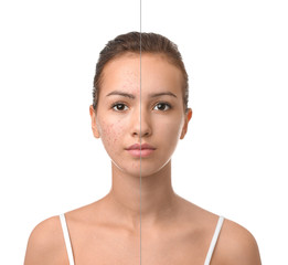 Teenage girl before and after acne treatment on white background - obrazy, fototapety, plakaty