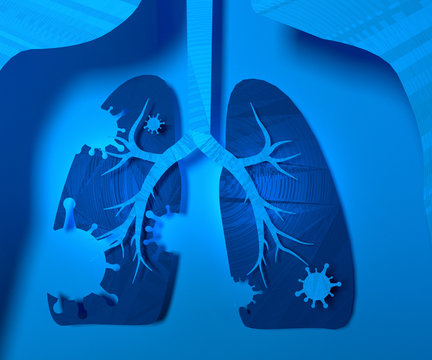 Virus and bacteria infected the Human lungs. lung disease.3d render. Illustration