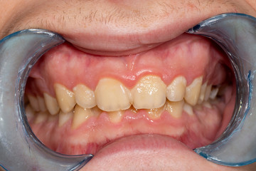 Caries and tooth disease. Filling with a dental composite photopolymer material using Rubber Dam....