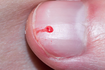Squeezed pimple with blood on the nail.