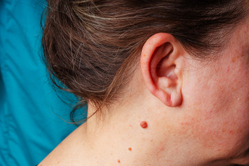Large mole near the ear close-up. A red mole on the neck of an elderly woman. A large round mole of...
