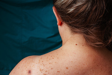 Age Spots Moles And Freckles On The Back Of An Older Woman Pigmentation On The Back Spots On The Body Fat Folds On The Sides Of The Body Overweight In Middle Aged