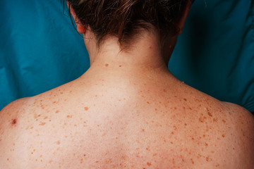 Age Spots Moles And Freckles On The Back Of An Older Woman Pigmentation On The Back Spots On The Body Fat Folds On The Sides Of The Body Overweight In Middle Aged