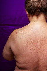 Age spots, moles, and freckles on the back of an older woman. Pigmentation on the back. Spots on...