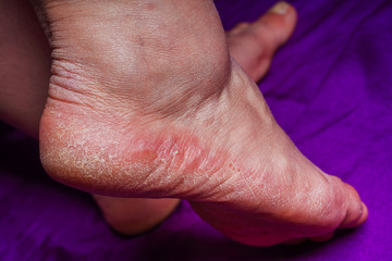 Skin allergic dermatitis redness on the foot. Old woman's legs. Cracks in the heels of women's...