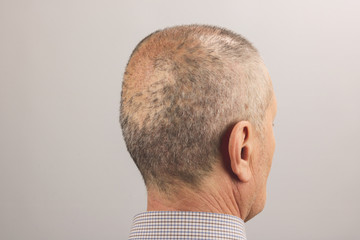 man head back two weeks after hair transplant