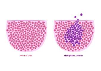 cancer; tumor; cells; malignant; stages; development; growth; anatomy; basal; biology; body; condition; diagnosis; diagram; disease; division; drawing; epithelial; epithelium; grow; growing; health; h