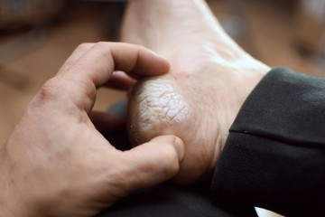 Dermatitis, sweating of the skin of the feet of a man due to bad shoes.