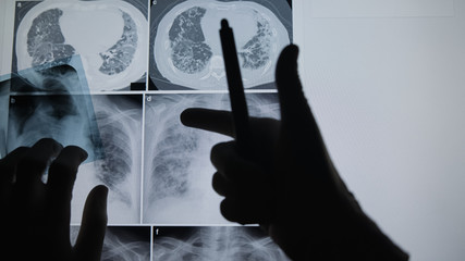 Doctor examining at lungs radiograph x-ray film of patient in operation room.