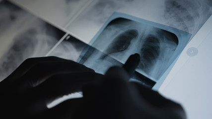 Doctor examining at lungs radiograph x-ray film of patient in operation room.