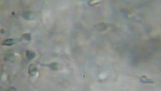 Moving Human Sperm Under Phase Contrast Microscope. Sperm (Spermatozoa) Viewed Under Microscope. Close Up Showing Spermatozoon. Video Human Semen. Macro Closeup. Medical Science Laboratory.
