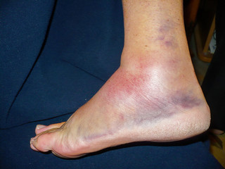 detail of ankle injury with dislocation and sprains