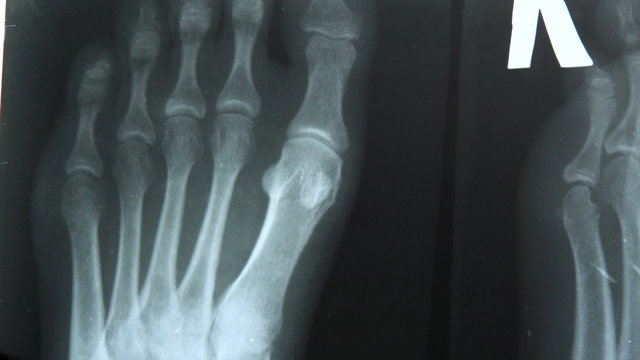 X-ray of the feet close-up. X-ray image from top to bottom.