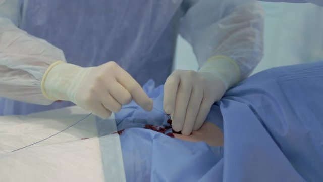 Close-up of doctor&rsquo;s hands in operating room, doctor starts operation to remove a blood clot, blood flows from catheter, inserts probe into circulatory system, thin wire, new treatment methods