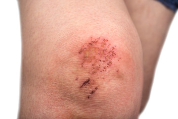 Fototapeta premium Woman scratch skin on the knee. Injury concept