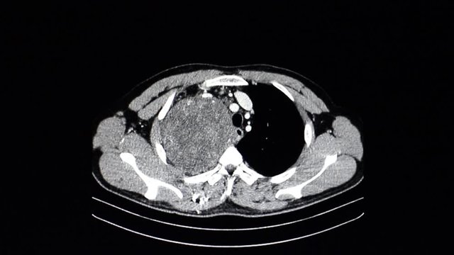 Cineview of CT scan of a chest of patient showing large tumor in right chest cavity. 