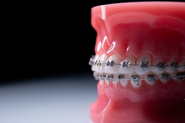 Close-up of teeth with metal braces. The jaw with braces turns on the surface.