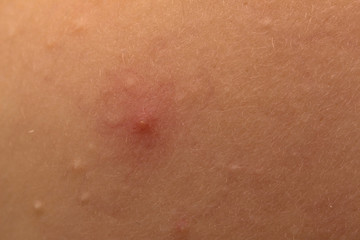 Fototapeta premium Rash of sweets on a child's cheek