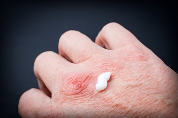 White cream on hand with chapped skin due to exposure to cold