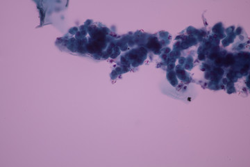 View in microscopic of Candidiasis, fungus infection (Yeast and Pseudohyphae form) in pap smear...