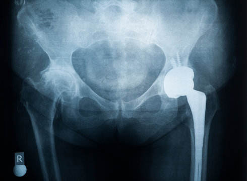 X-ray of the prosthesis of the left hip joint. The right joint is affected by rheumatoid arthritis