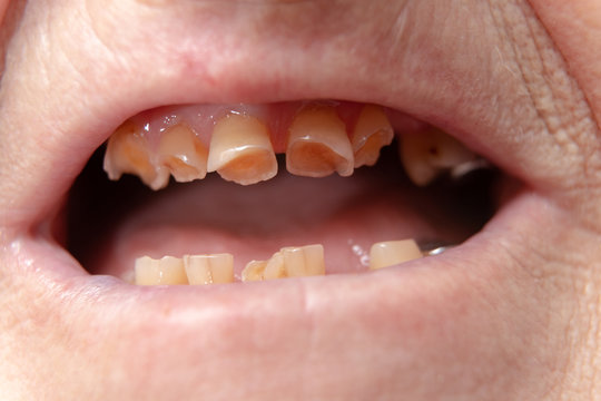 The teeth of an adult erased from old age. Cracks and holes in unhealthy teeth.